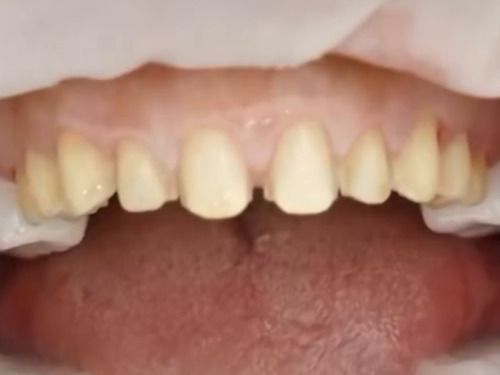 Diseño de sonrisa · carillas: antes