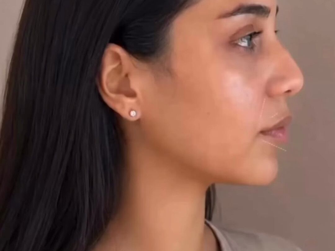 Balanceamiento facial: antes