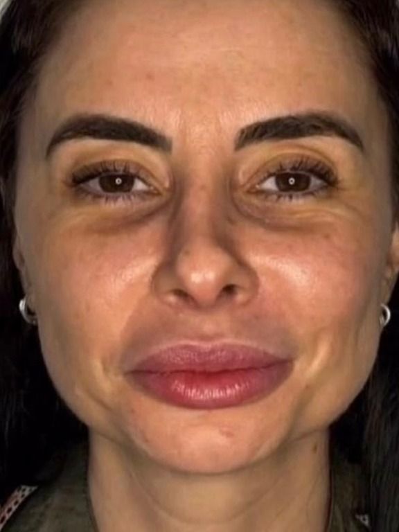Armonización facial: antes
