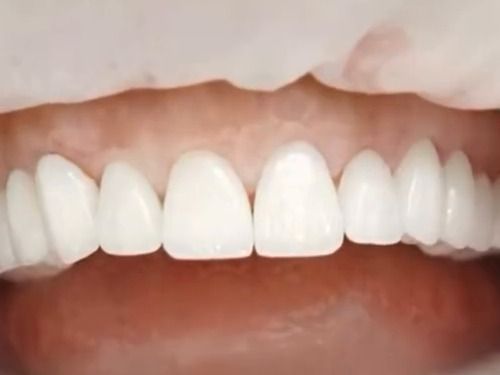 Diseño de sonrisa · carillas: después