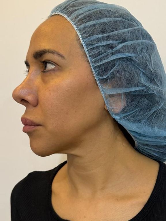 Endolifting láser, perfil: antes