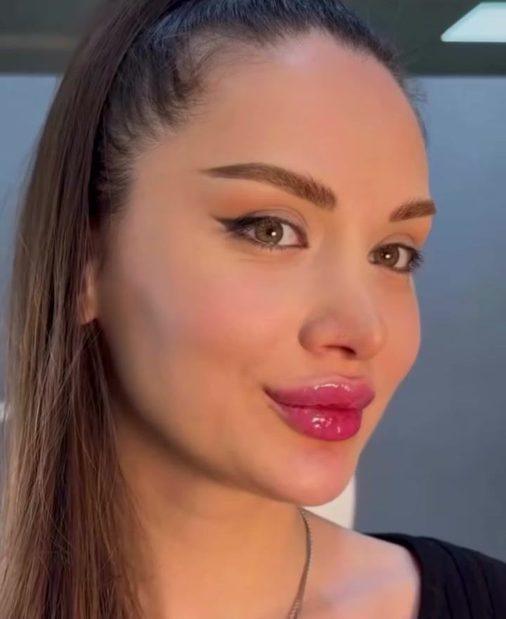 Paciente con labios hidratados y rostro armonizado